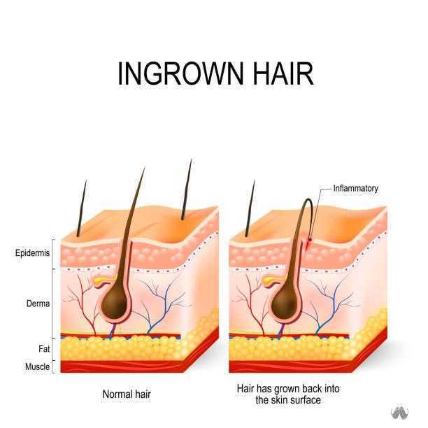 Ingrown hair after having vector art illustration Tweeze Ingrown Hair